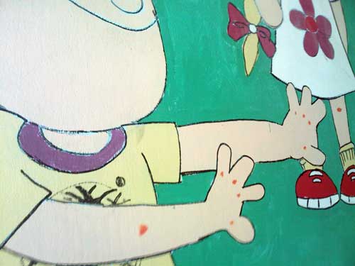 Cases of hand foot and mouth disease are increasing Cases of hand foot and mouth disease are increasing